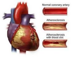 cara cepat atasi penyakit arteri koroner